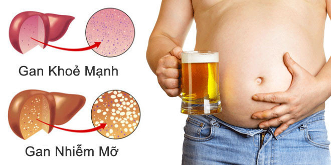 Uống bia nhiều làm tăng nguy cơ mắc các bệnh về gan