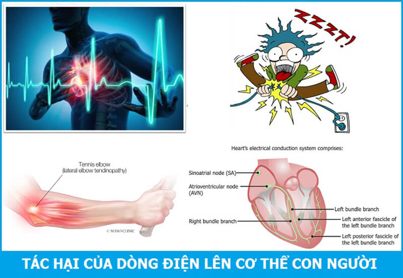 Tác hại nghiêm trọng của tai nạn điện giật Tác hại nghiêm trọng của tai nạn điện giật